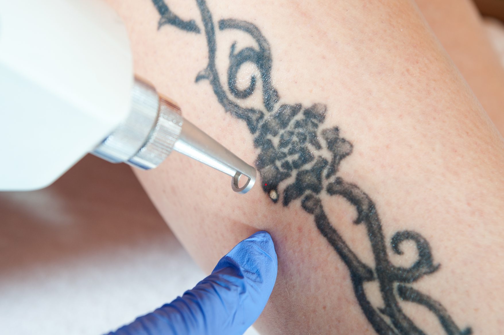 Tattoo Removal at Indyu Skin Clinic & Cosmetology Centre, Kochi