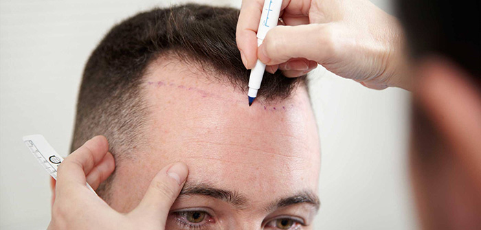 Hair Transplant services at Indyu Skin Care Clinic & Cosmetology Centre, Kochi, Elamakkara, Kakkanad