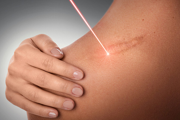 Stretch Marks Removal at Indyu Skin Clinic & Cosmetology Centre, Kochi